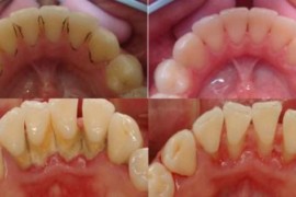 Pulizia dentale: cosa dobbiamo sapere