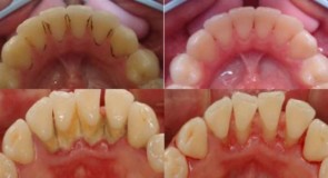 Pulizia dentale: cosa dobbiamo sapere