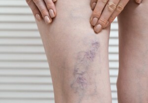 Le vene varicose non sono solo un fatto estetico: cosa succede davvero nel nostro corpo