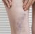 Le vene varicose non sono solo un fatto estetico: cosa succede davvero nel nostro corpo