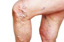 Vene varicose: quando l’inestetismo nasconde un problema più profondo