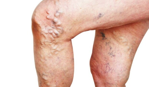 Vene varicose: quando l’inestetismo nasconde un problema più profondo