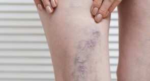 Vene varicose e salute delle gambe: oltre l’estetica, un problema circolatorio